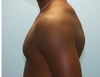 Gynecomastia Before & After Patient #8443
