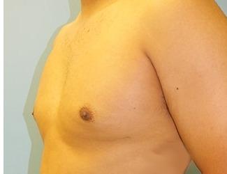 Gynecomastia Before & After Patient #8441