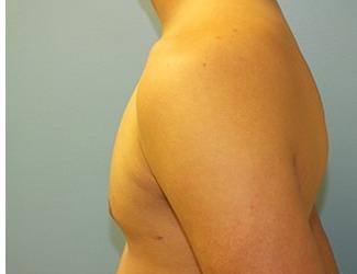 Gynecomastia Before & After Patient #8439