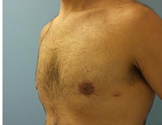 Gynecomastia Before & After Patient #8435