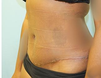 Tummy Tuck Before & After Patient #8192