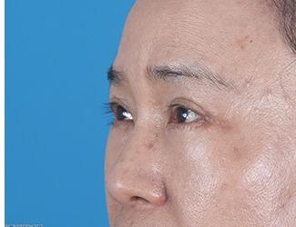 Browlift Before & After Patient #8460