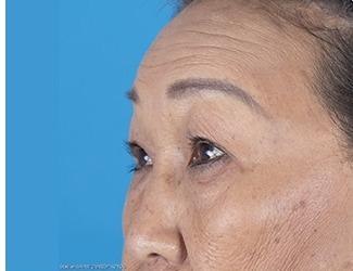 Browlift Before & After Patient #8457