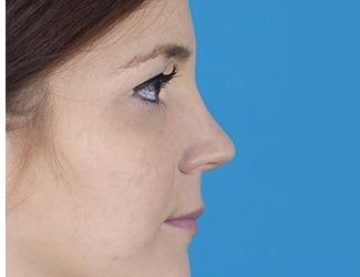 Rhinoplasty Before & After Patient #8809