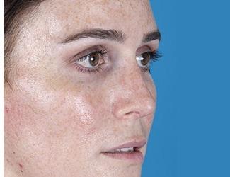 Rhinoplasty Before & After Patient #8808