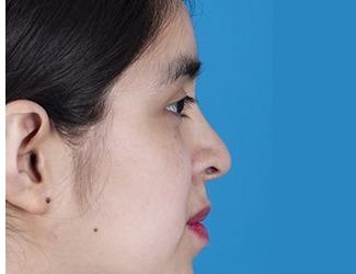 Rhinoplasty Before & After Patient #8807