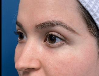 Blepharoplasty Before & After Patient #8485