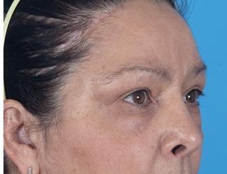 Blepharoplasty Before & After Patient #8484