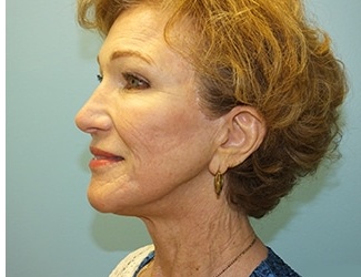 Facial Fat Grafting Before & After Patient #8745