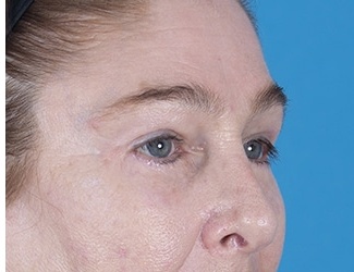 Facial Fat Grafting Before & After Patient #8748