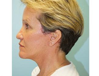 Facial Fat Grafting Before & After Patient #8741