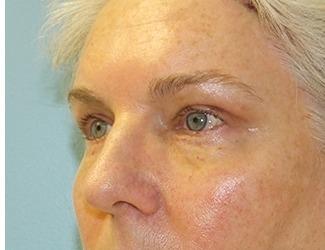 Facial Fat Grafting Before & After Patient #8744