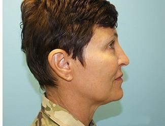 Facial Fat Grafting Before & After Patient #8742