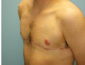 Female to Male Before & After Patient #8442