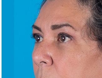 Facial Fat Grafting Before & After Patient #8743