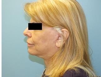 Facial Fat Grafting Before & After Patient #8740