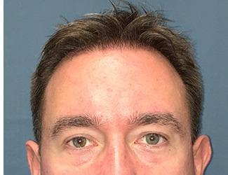 NeoGraft Before & After Patient #8827