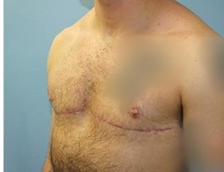 Female to Male Before & After Patient #8440