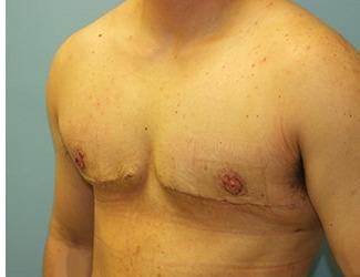 Female to Male Before & After Patient #8444
