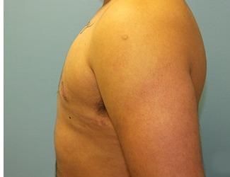 Female to Male Before & After Patient #8438