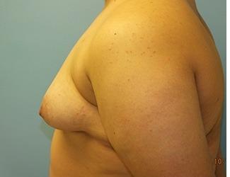 Female to Male Before & After Patient #8437
