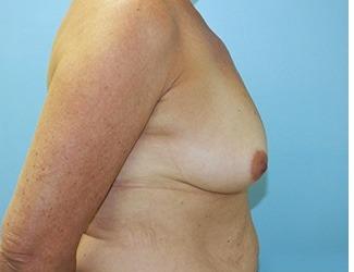Breast Augmentation Before & After Patient #8244
