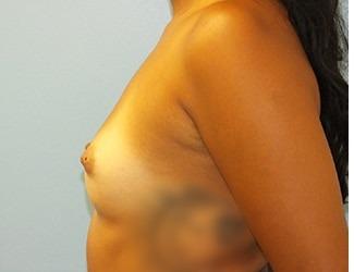 Breast Augmentation Before & After Patient #8245