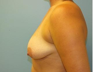 Breast Lift/Mastopexy Before & After Patient #8367
