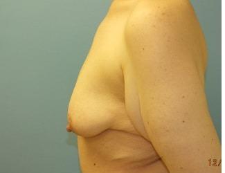 Breast Lift/Mastopexy Before & After Patient #8370
