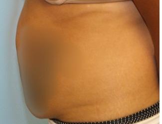Tummy Tuck Before & After Patient #8199