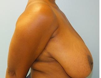 Breast Reduction Before & After Patient #8416