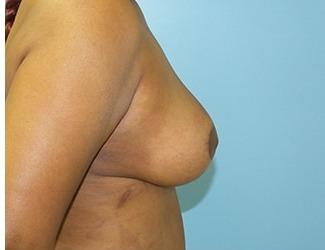 Breast Reduction Before & After Patient #8419