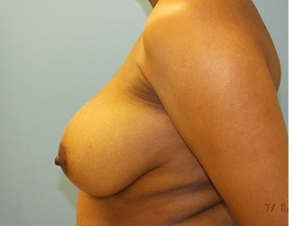 Breast Reduction Before & After Patient #8411