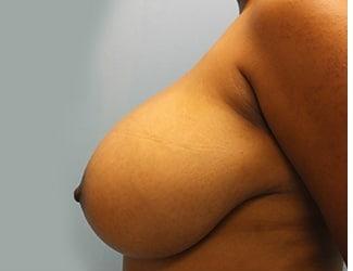 Breast Reduction Before & After Patient #8414