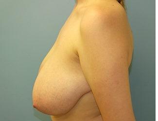 Breast Reduction Before & After Patient #8417