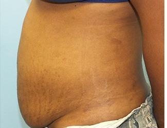 Tummy Tuck Before & After Patient #8195