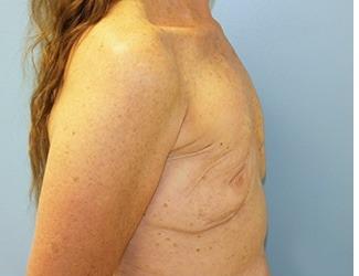Breast Revision Before & After Patient #8240