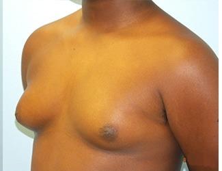 Gynecomastia Before & After Patient #8443