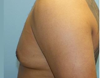 Gynecomastia Before & After Patient #8441