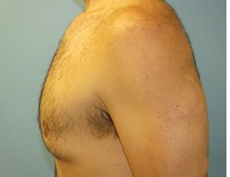 Gynecomastia Before & After Patient #8435