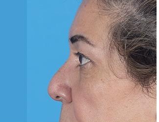 Browlift Before & After Patient #8459