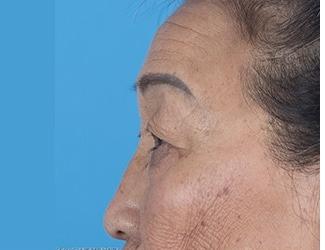 Browlift Before & After Patient #8457