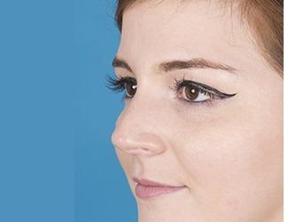 Rhinoplasty Before & After Patient #8809