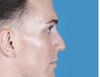 Rhinoplasty Before & After Patient #8808