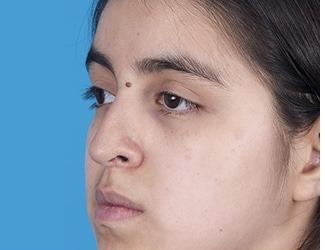 Rhinoplasty Before & After Patient #8807
