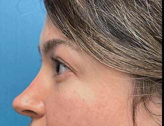 Blepharoplasty Before & After Patient #8485