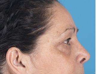 Blepharoplasty Before & After Patient #8484