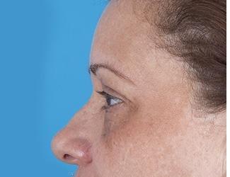 Blepharoplasty Before & After Patient #8481