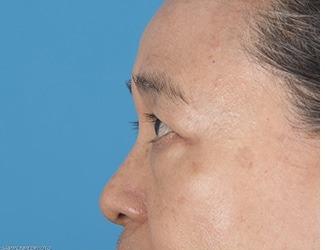 Blepharoplasty Before & After Patient #8483