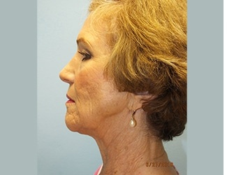 Facial Fat Grafting Before & After Patient #8745